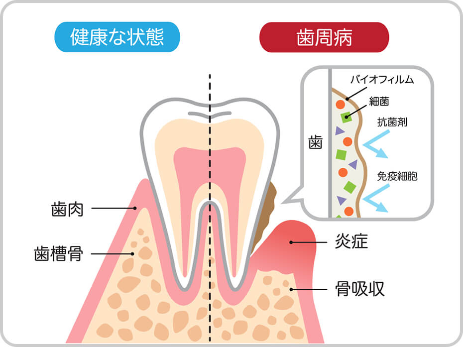 歯周病治療