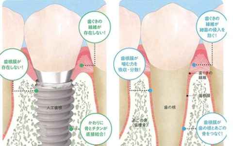 インプラントと天然歯はなにが違う？
