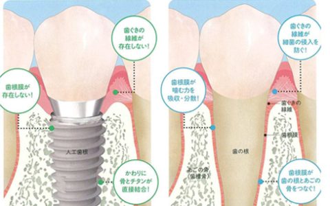 インプラントと天然歯はなにが違う？