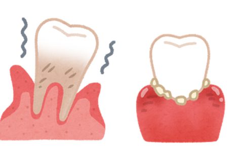 歯周病による体のひずみとは