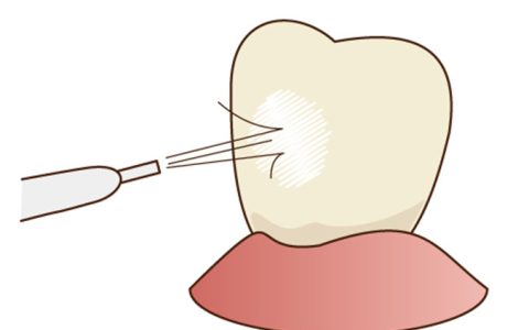 歯周病をふせぐ歯磨きの方法とは