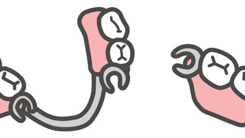 部分入れ歯