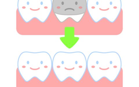 銀歯からセラミックにできる？