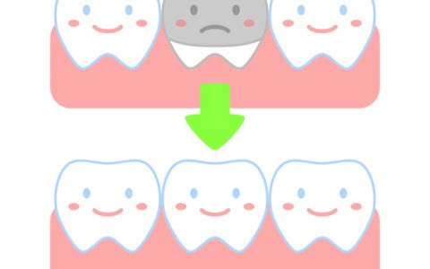 銀歯からセラミックにできる？