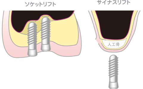 難しいインプラント症例