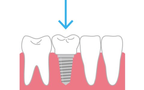 インプラントとは？