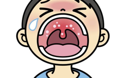 一度は経験したことのある口内炎