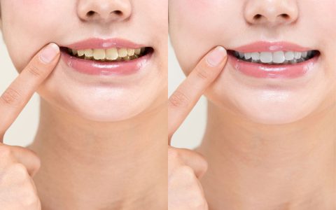 ホワイトニングはどれくらい持つ？長持ちさせる秘訣！