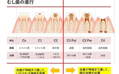 あなたの虫歯の状態教えます！