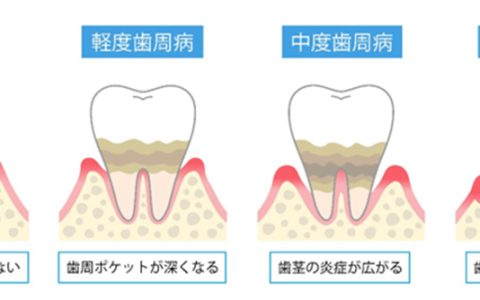 歯周病が引き起こす危険性や影響とは？