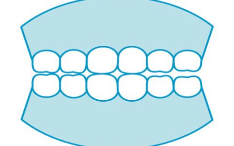 ブリッジと入れ歯の違いとは？