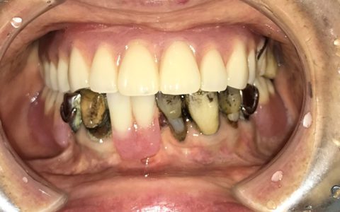 お口の中が黒いのは「衰え」のサイン？　鉄剤と口腔機能の意外な関係