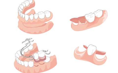 入れ歯とブリッジの特徴について