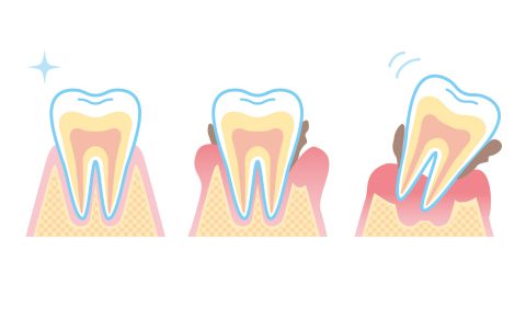 未来の自分のための歯ぐきケア