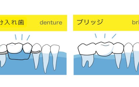 歯を失ったらどうしたらいい？入れ歯とブリッジの違い